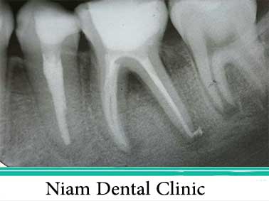 عصب کشی دندان|عصب کشی 